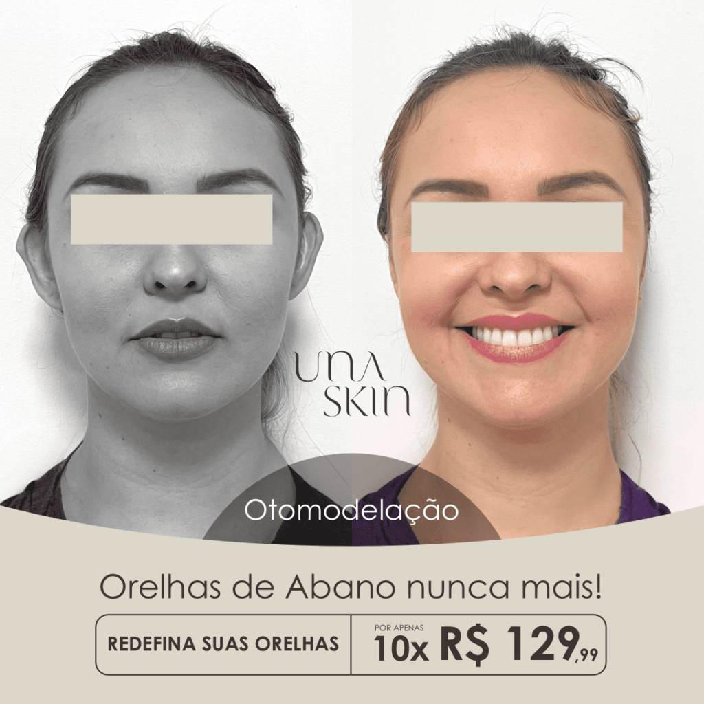 Harmonização de Orelhas de R$1890 por apenas 10xR$129,99