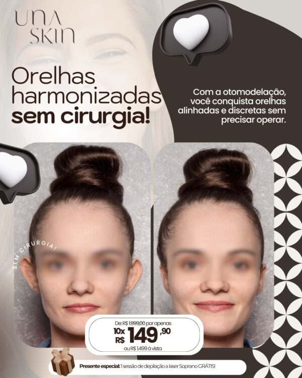 Harmonização de Orelhas (Otomodelação) de R$1.890 por apenas 1.499 em até 10X Sem Juros - Image 2