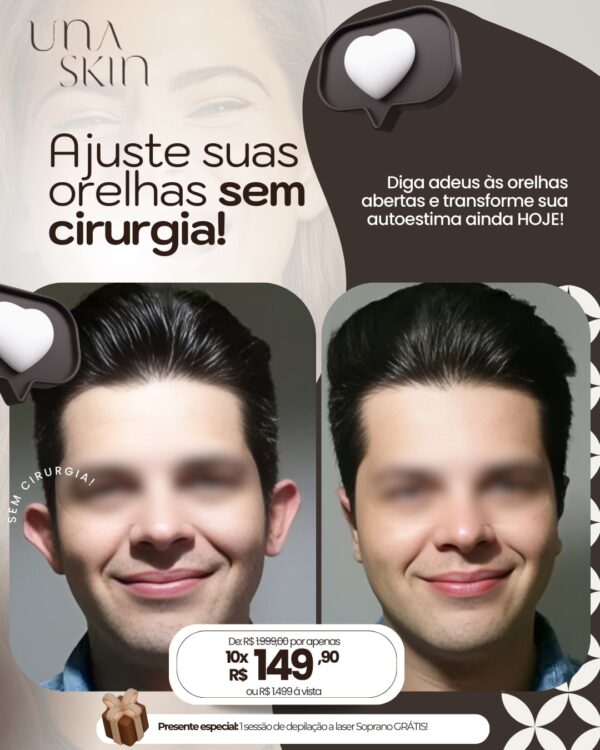 Harmonização de Orelhas (Otomodelação) de R$1.890 por apenas 1.499 em até 10X Sem Juros - Image 3