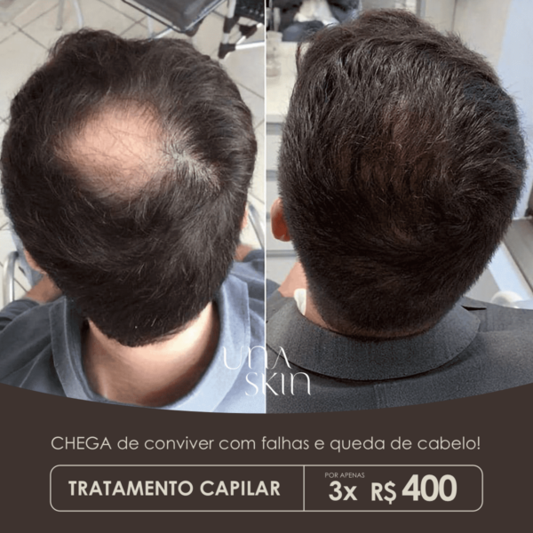 Tratamento Capilar 3 Sessões de R$1.800 por R$ 1.200 ou 3x R$400 Sem Juros